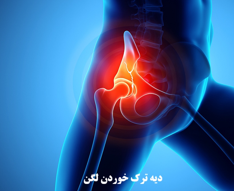 دیه ترک خوردن لگن در سال 1404