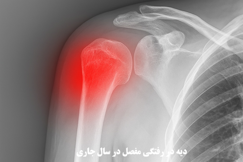 دیه در رفتگی مفصل در سال 1404