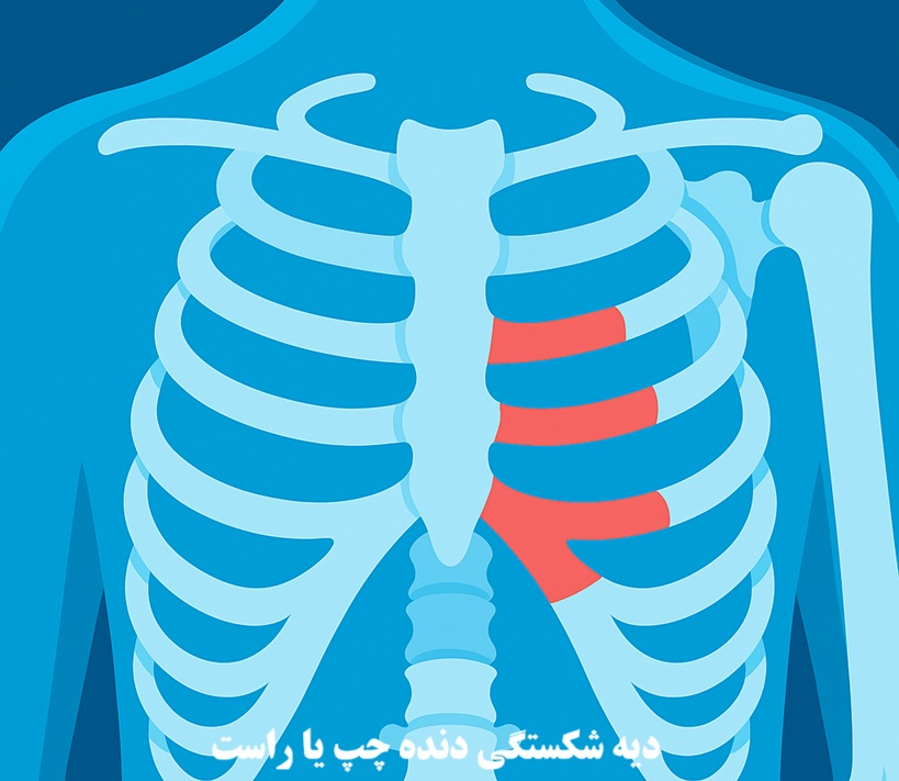 دیه شکستگی دنده چپ و راست در سال 1404