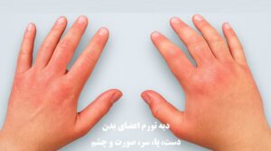 دیه تورم اعضای بدن در سال ۱۴۰۴