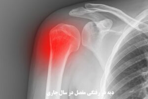 دیه در رفتگی مفصل در سال 1404