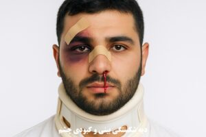 دیه شکستگی بینی و کبودی چشم
