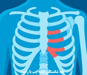 دیه شکستگی دنده چپ و راست در سال 1404