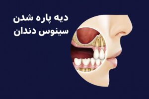 دیه پاره شدن سینوس دندان