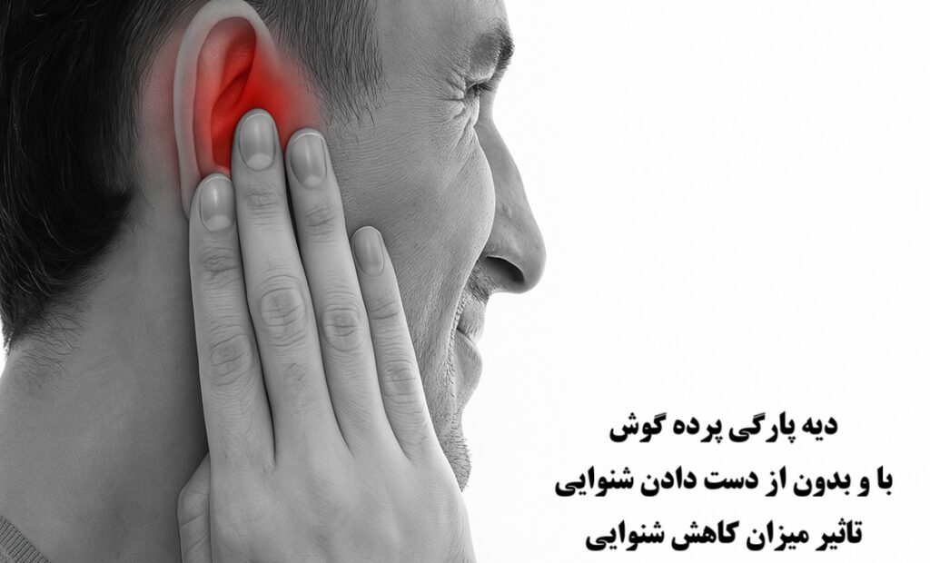 دیه پارگی پرده گوش در سال ۱۴۰۴ با و بدون از دست دادن شنوایی