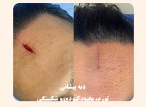 دیه پیشانی؛ جدول دیه بخیه، کبودی، شکستگی و ارش پیشانی