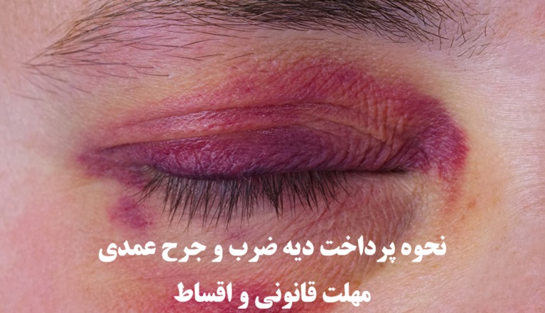 نحوه پرداخت دیه ضرب و جرح عمدی